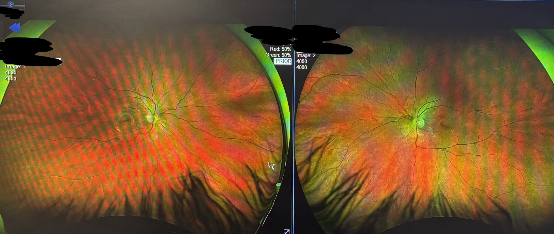 Fundus photo of Madison's eyes