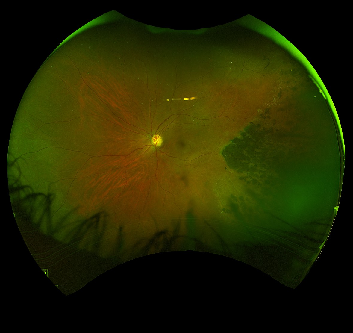 retina imaging